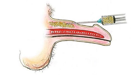 Injektionen von Hyaluronsäure in den Lauf eines Mitglieds, um es zu erhöhen